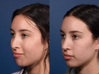 18-24 year old woman treated with Revision Rhinoplasty
