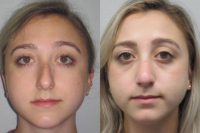 18-24 year old woman treated with Rhinoplasty and Septoplasty