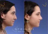 22 year old woman treated with Rhinoplasty