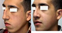 18-24 year old man treated with Orthognathic Surgery
