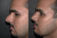 18-24 year old man treated with Revision Rhinoplasty