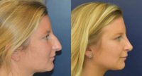 18-24 year old woman treated with Septoplasty