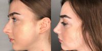 18-24 year old woman treated with Septorhinoplasty