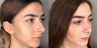 18-24 year old woman treated with Septorhinoplasty