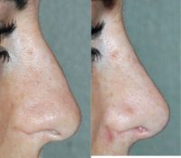 18-24 year old woman treated with Rhinoplasty