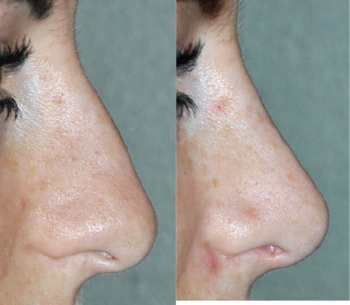 Year Old Wife Treated With Crooked Nose Rhinoplasty Image By Dr Eppley Carmel Indiana