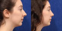 18-24 year old woman treated with Rhinoplasty