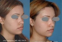 18-24 year old woman treated with Rhinoplasty and nasal dorsal implant