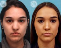 18-24 year old woman treated with Revision Rhinoplasty - Cleft nose with upper lip fat grafting