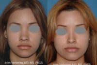 18-24 year old woman treated with Rhinoplasty with nasal dorsal implant