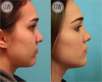 18-24 year old woman treated with Revision Rhinoplasty - Cleft rhinoplasty with fat grafting to lip