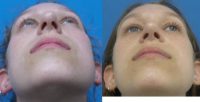 25 year old  -  Rhinoplasty/Septoplasty/Partial Turbinectomy  -  7 months post-op