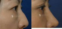 25-34 year old woman treated with Rhinoplasty and upper eyelid surgery