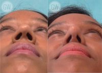 25-34 year old woman treated with Rhinoplasty and alar base reduction