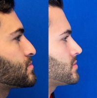 25-34 year old male treated with Rhinoplasty