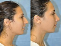 27 Year Old Treated for Unacceptable Cosmetic Appearance of Nose