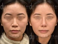25-34 year old woman treated with Asian Rhinoplasty