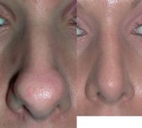 25-34 year old woman treated with Rhinoplasty