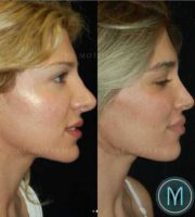 25-34 year old woman treated with Facial Fat Transfer