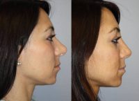 30 year old female requesting revision rhinoplasty