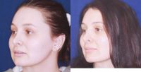 25-34 year old woman treated with Permanent Non Surgical Nose Job
