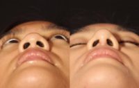 25-34 year old woman treated with Asian Rhinoplasty