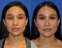 25-34 year old woman treated with Revision Rhinoplasty