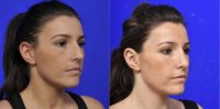 25-34 year old woman treated with Open Septorhinoplasty