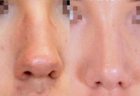 25-34 year old woman treated with Rhinoplasty