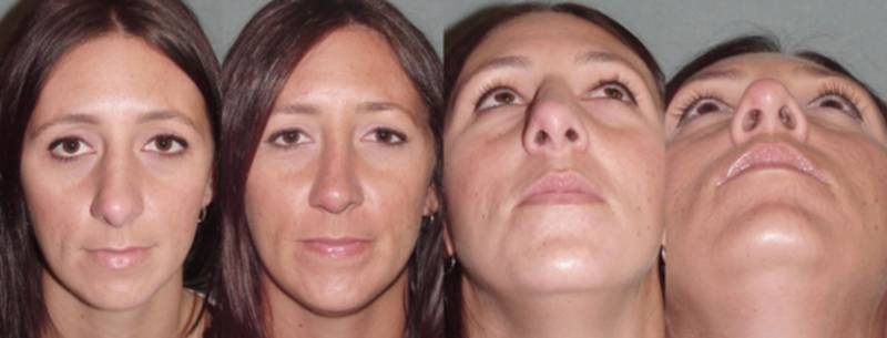 31 Year Old Miss Treated With Revision Rhinoplasty Surgery ...