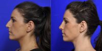 25-34 year old woman treated with Open Septorhinoplasty