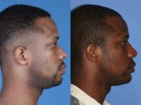 25-34 year old man treated with African American Rhinoplasty