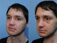 25-34 year old man with crushed nose treated with Rhinoplasty with allograft bone