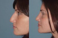 25-34 year old woman treated with Rhinoplasty, Septoplasty and Endoscopic Sinus Surgery