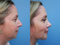 35-44 year old woman treated with Revision Rhinoplasty and chin augmentation