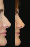 35-44 year old woman treated with Nonsurgical Nose Job
