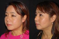 35-44 year old woman treated with Asian Rhinoplasty