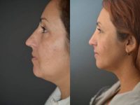 38 year old woman treated with Rhinoplasty
