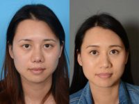 35-44 year old woman treated with Asian Rhinoplasty