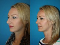 35-44 year old woman treated with Rhinoplasty & Chin Implant