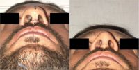 35-44 year old man treated with Third Revision Nose Surgery Front Tip