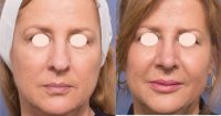 45-54 year old woman treated with Cheek Augmentation and Rhinoplasty