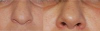 45-54 year old woman treated with Rhinoplasty for nostril reduction and tip elevation
