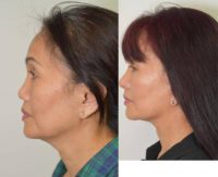 55-64 year old woman treated with Revision Rhinoplasty