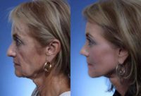 69 year old woman treated with Facelift, Fractional CO2 Laser, Rhinoplasty