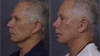 65-74 year old male treated with Facelift