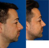 Combined Rhinoplasty and Silicone Chin Implantation