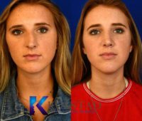 Rhinoplasty with Correction of Deviated Septum and Hump Removal