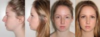 rhinoplasty vancouver before and after photos