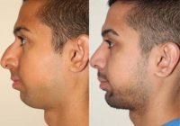 18-24 year old man treated with Chin Implant and Rhinoplasty